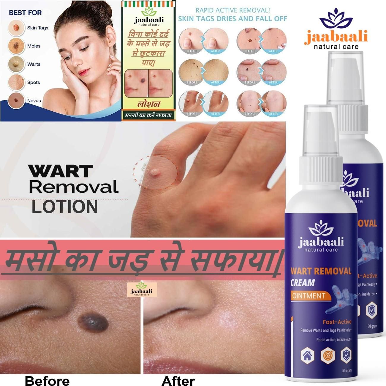 Wart Remover Cream (Pack of 2) bqu5q7-dm